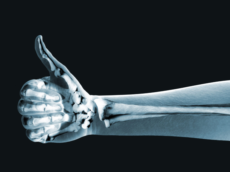 X-ray of a hand giving a thumbs-up