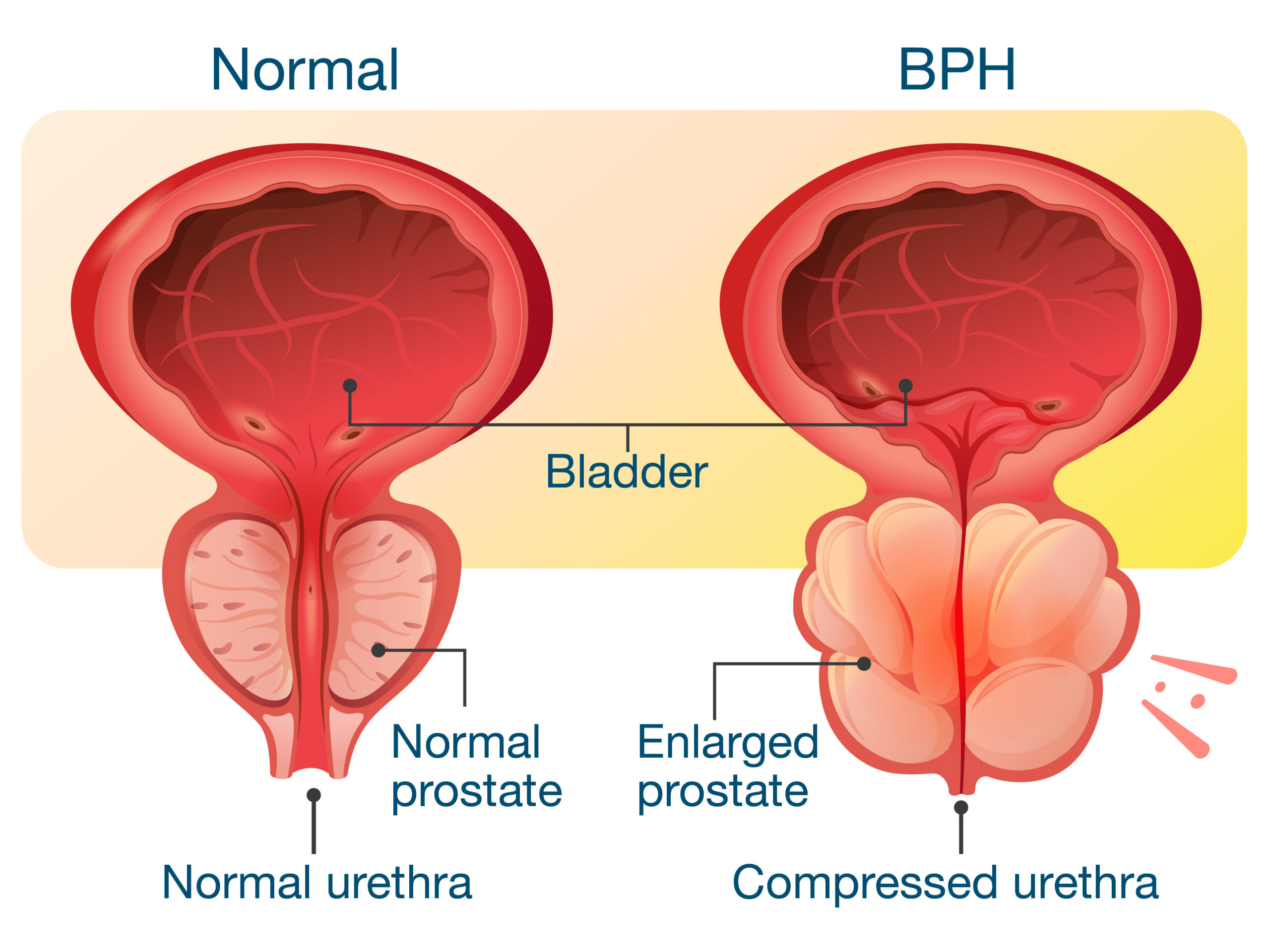 Graphic comparing a normal prostate to an enlarged prostate